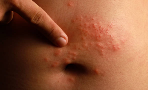 Rash from stress on the stomach refers to the development of a skin rash on the abdominal area triggered or worsened by heightened stress levels.