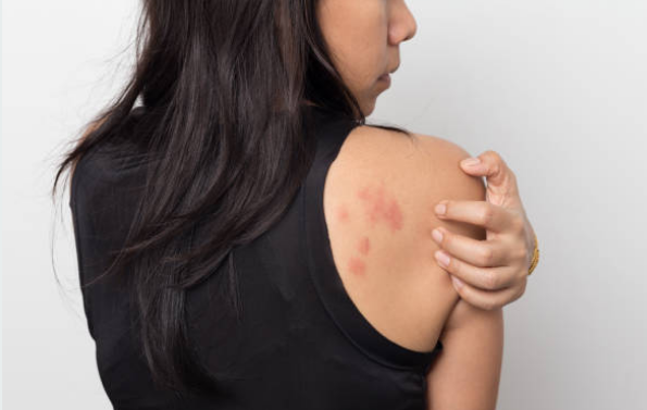 A stress rash can appear as red, inflamed patches or bumps on the skin.