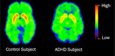 Individuals with ADHD may show variations in brain activity patterns, particularly in regions associated with attention and inhibition, compared to those with normal brain function.