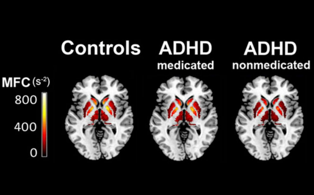 ADHD can lead to challenges in maintaining focus, planning, and inhibiting impulsive behaviors. These difficulties might be less pronounced in individuals with normal brain function.