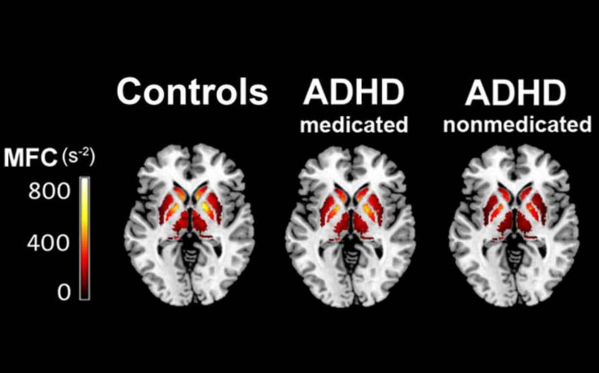 What Is ADHD Brain? Learn ADHD Brain Vs Normal Brain.