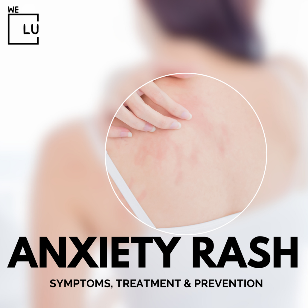 If you think you have an anxiety rash, consult We Level Up mental health professionals for a proper diagnosis and guidance on managing both the inflammation and the underlying anxiety.