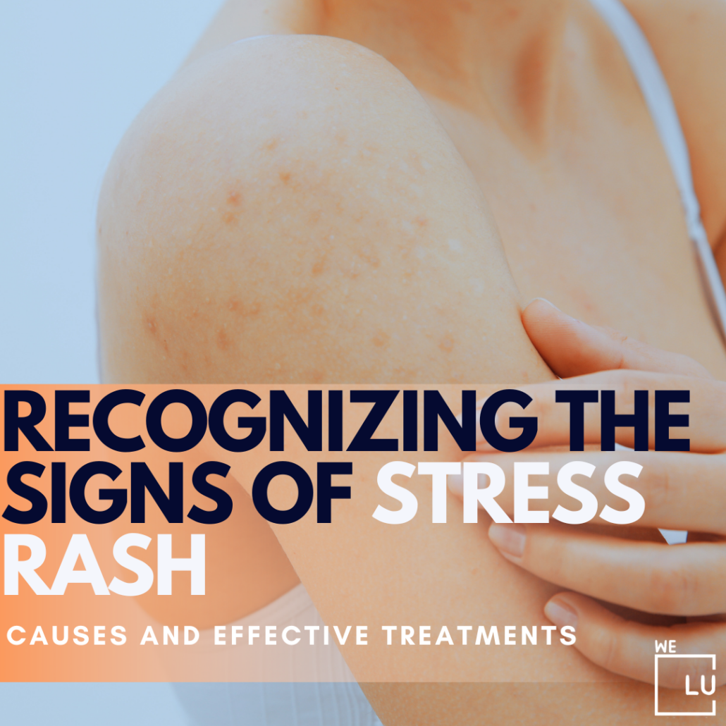 Anxiety can cause stress rashes by increasing stress levels and emotional strain, leading to skin reactions like hives. The body's response to anxiety can change the skin, causing discomfort and visible rashes.
