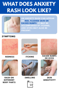 Anxiety Rash Symptoms, Causes, Treatment, And Prevention