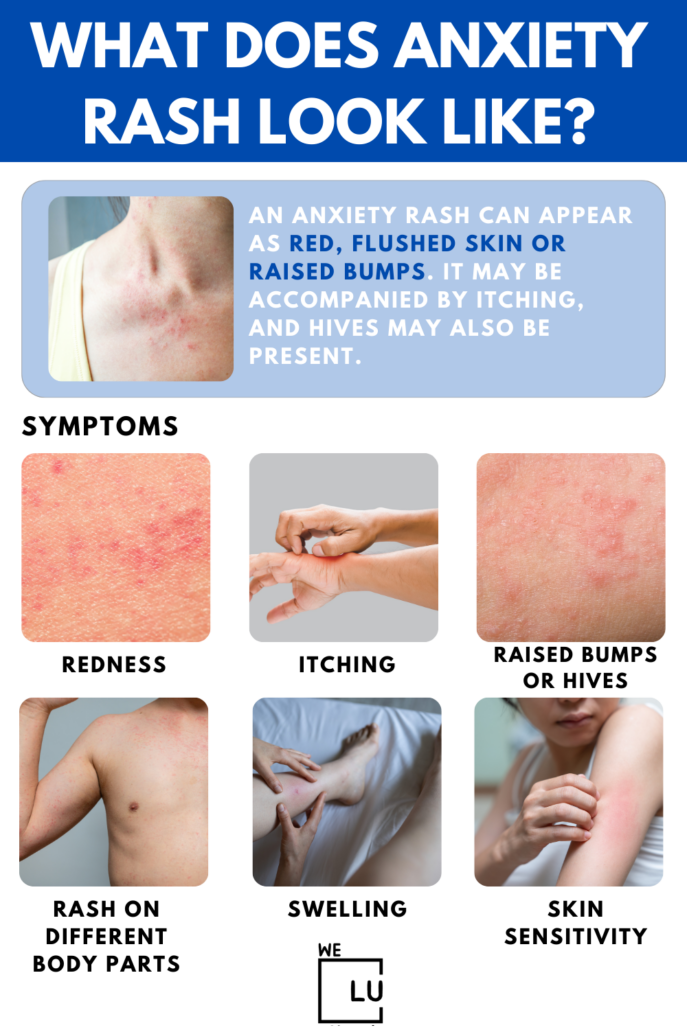 The rash from anxiety may be itchy, inflamed, and spread to different body parts. In some cases, anxiety rash may resemble an allergic reaction, with welts or patches of redness.